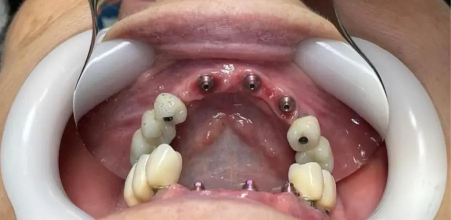 Caso 1: sorriso antes do tratamento