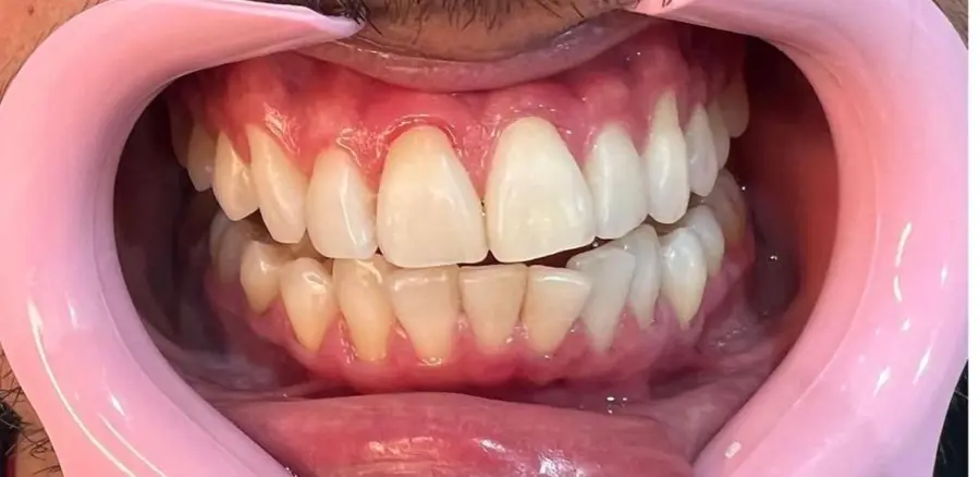 Caso 4: sorriso antes do tratamento