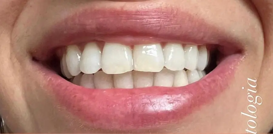 Caso 5: sorriso antes do tratamento