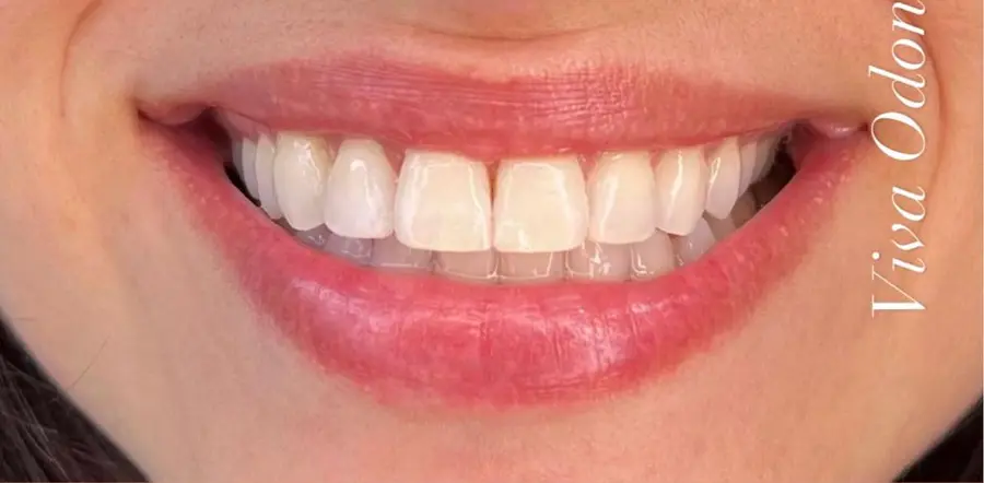 Caso 5: sorriso depois do tratamento